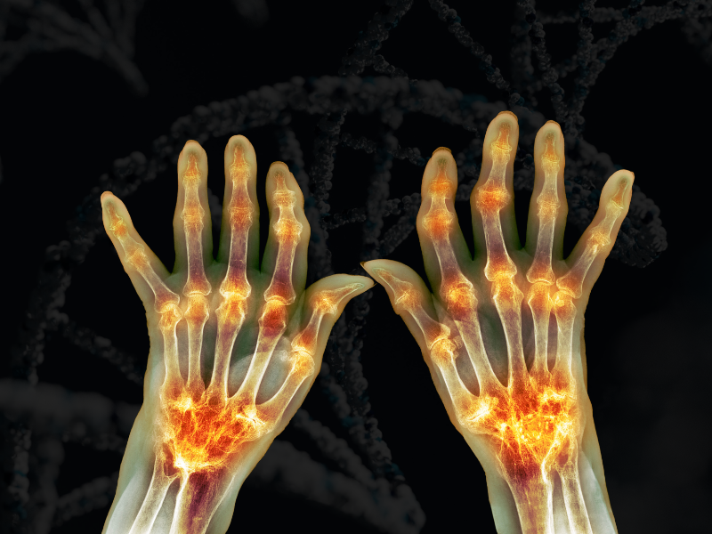 osteoarthritis gene therapy