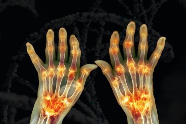 osteoarthritis gene therapy