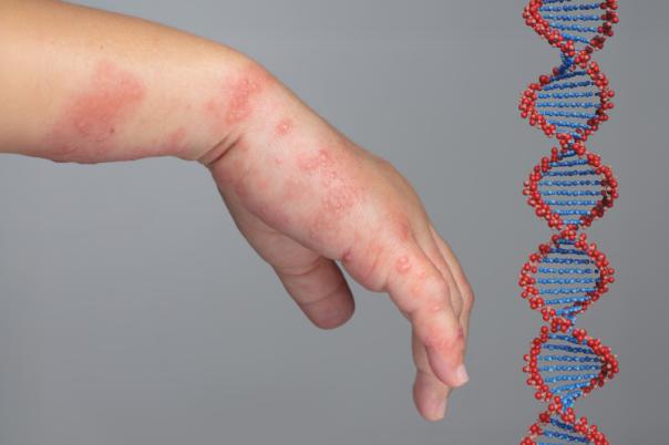 gene therapy deb